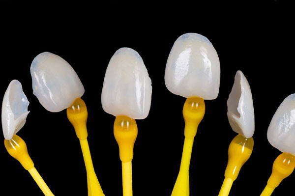 Composite Veneers